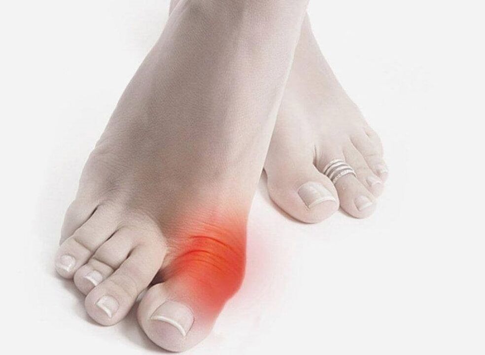 simptome de gută la picior